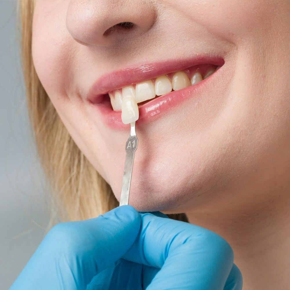 Illustration of veneers