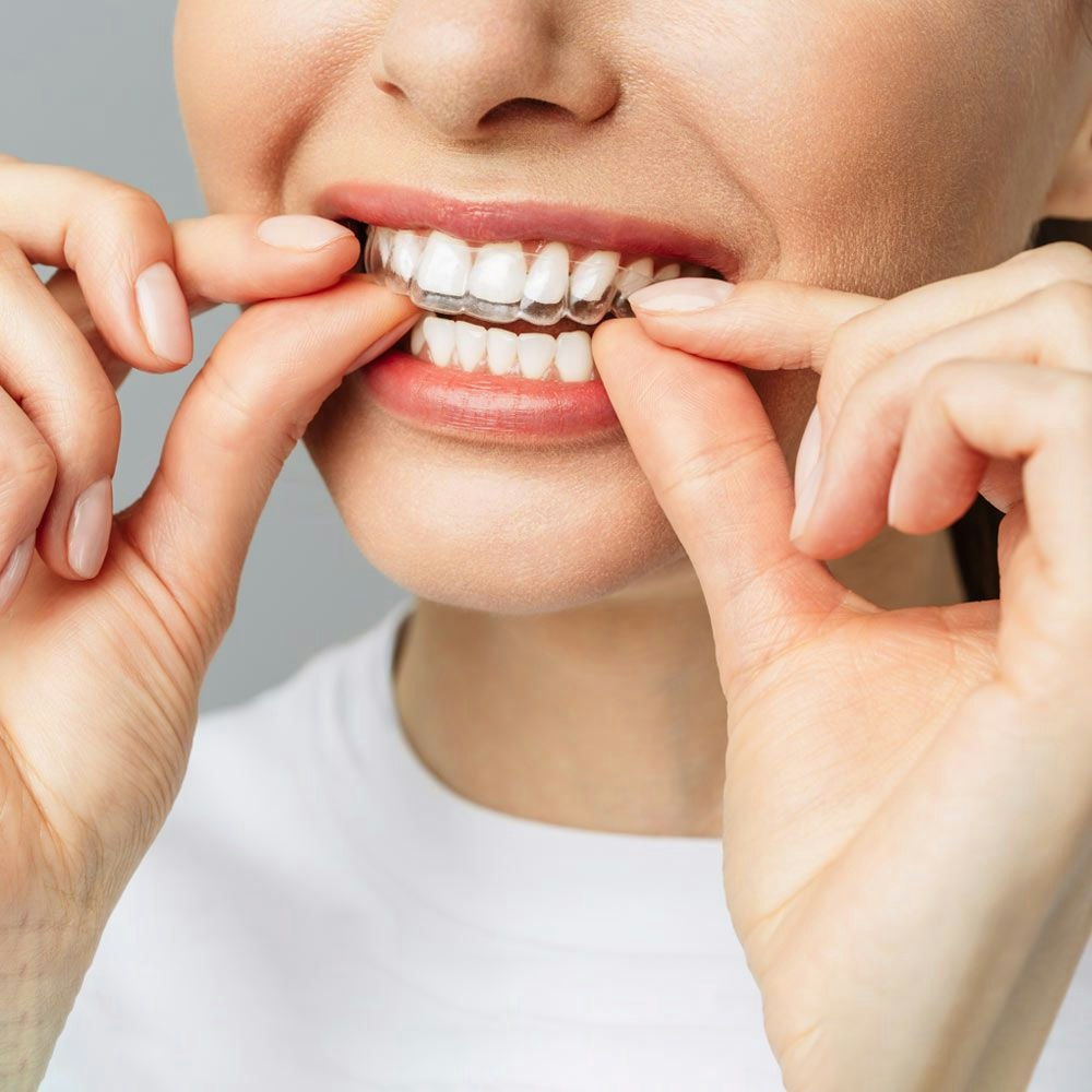 Woman placing clear aligner on teeth