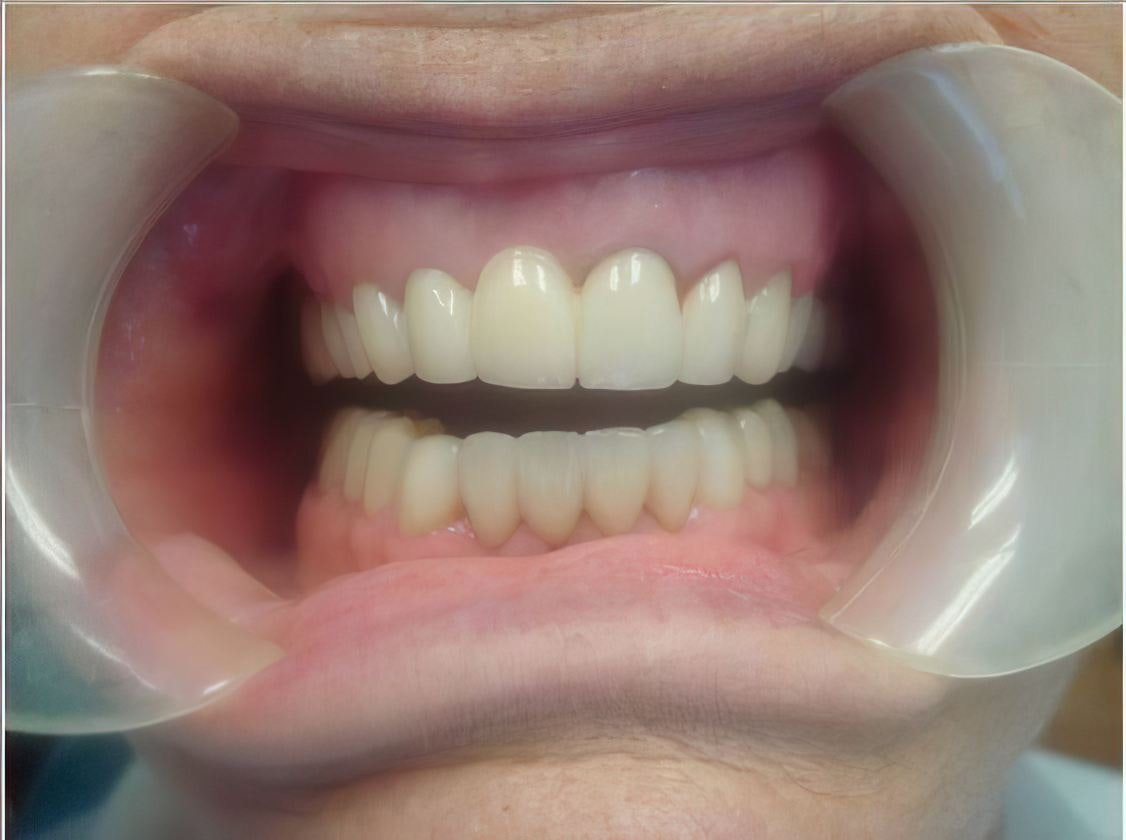 Case 3 after procedure