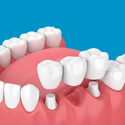 dental bridge