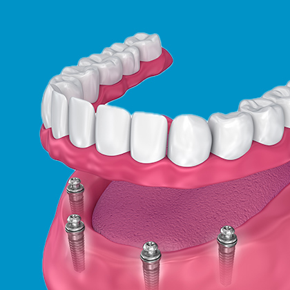 Implant denture