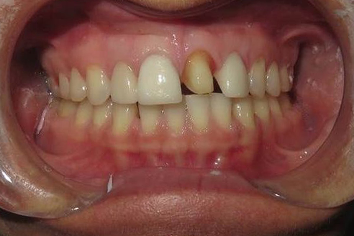 tooth before dental crown