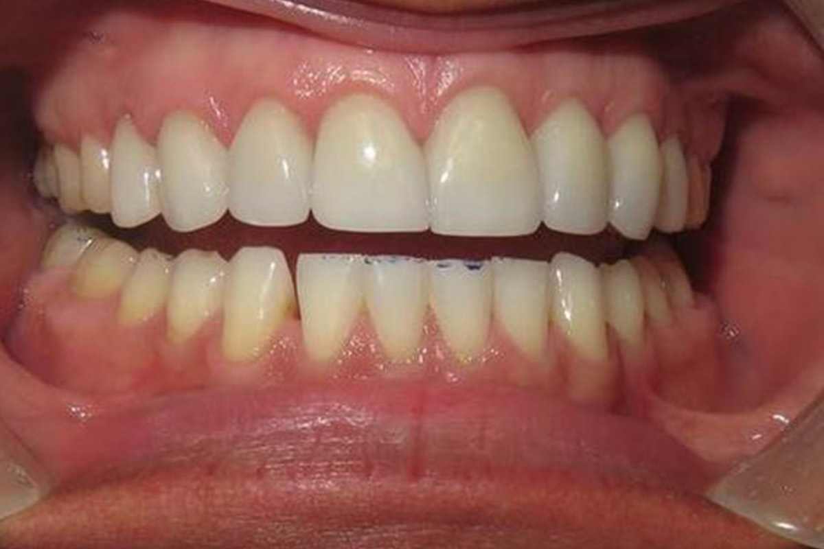 tooth after dental crown