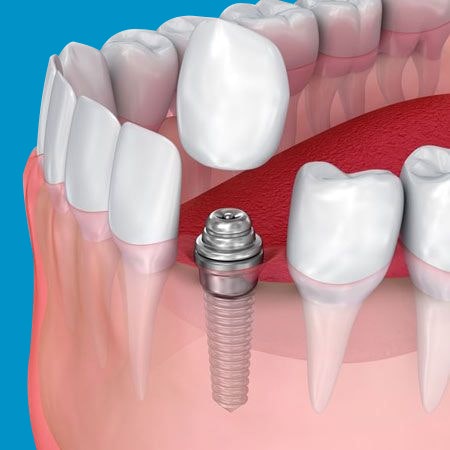 traditional dental implants on blue background