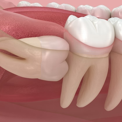 3D rendering of an impacted wisdom tooth
