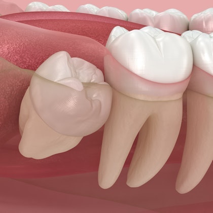 3D rendering of a wisdom tooth growing in slightly crooked