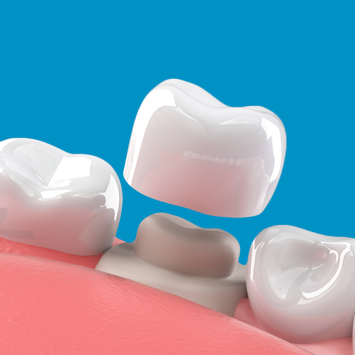 3d render of a dental crown application