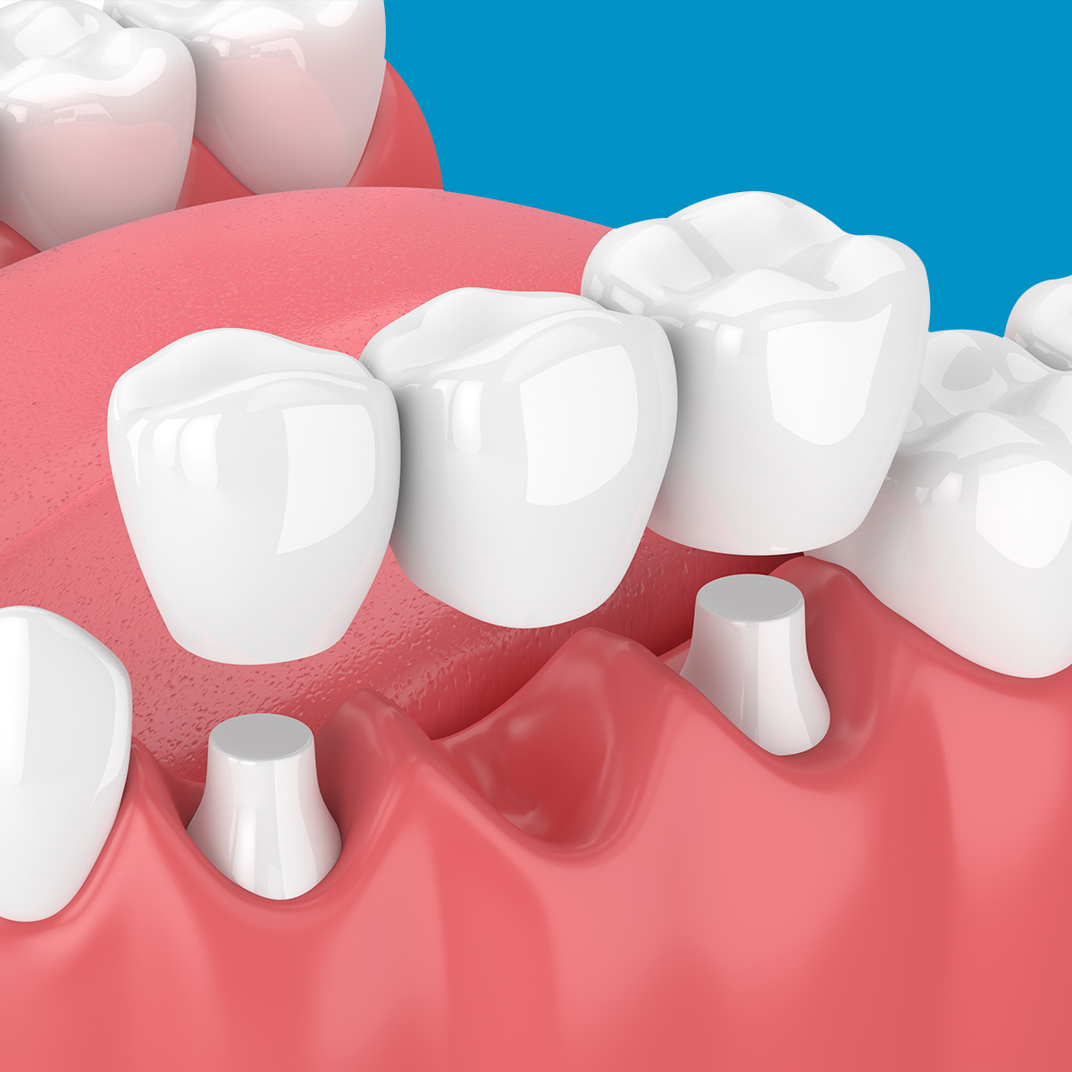 3d render of a dental bridge application