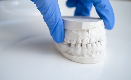 Plaster mold of a patient with malocclusion