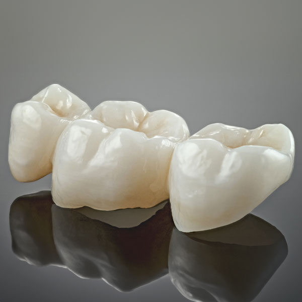 Dental bridge