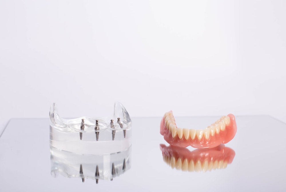 All-on-4 dental implants