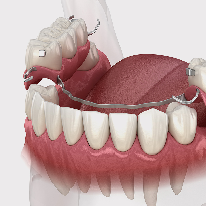 implant-supported dentures