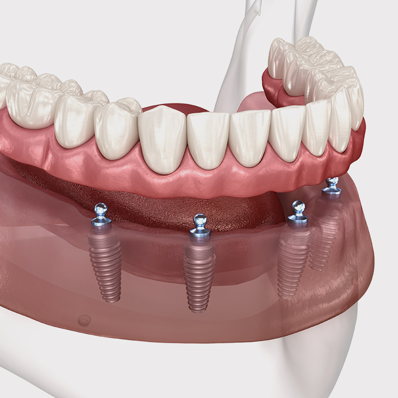 all-on-4 dentures