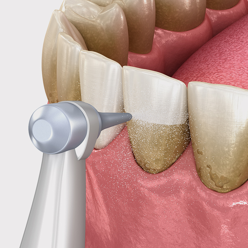 Close-up of a dental cleaning tool removing plaque and tartar from stained teeth near the gumline