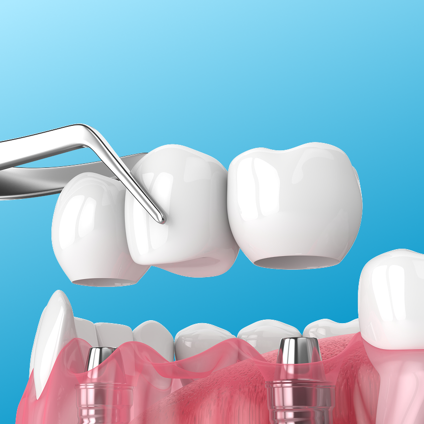 dental bridge