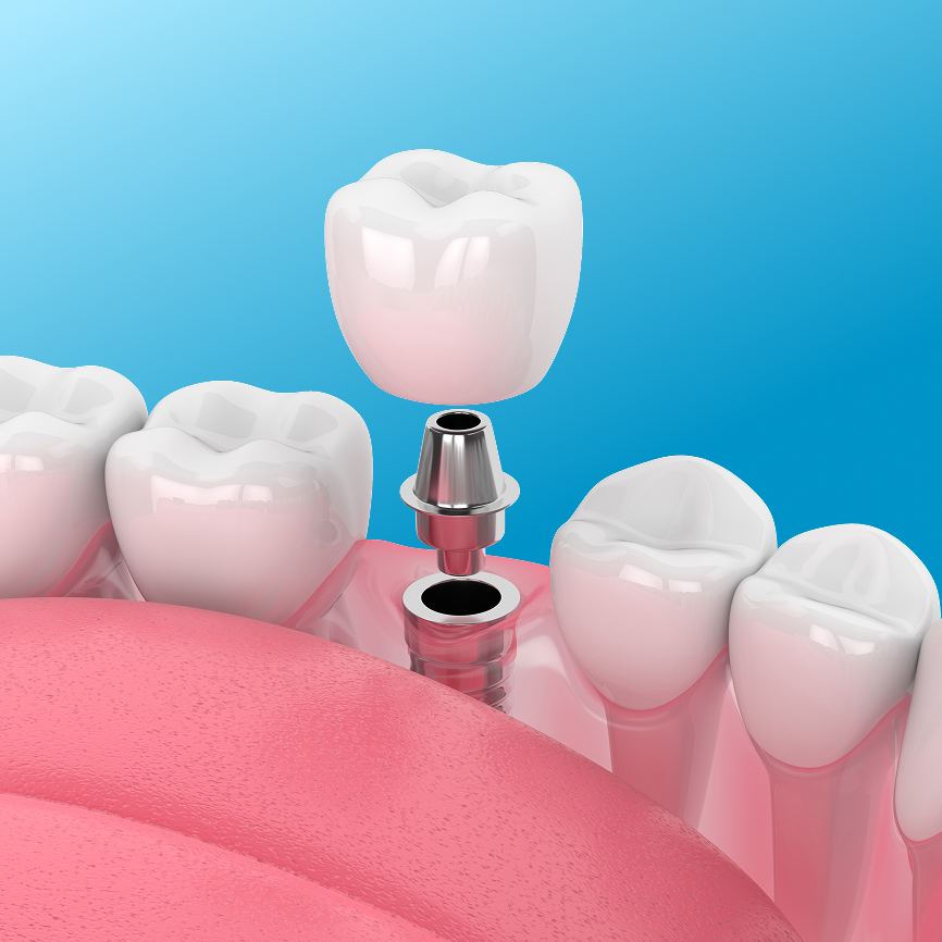 Dental crown