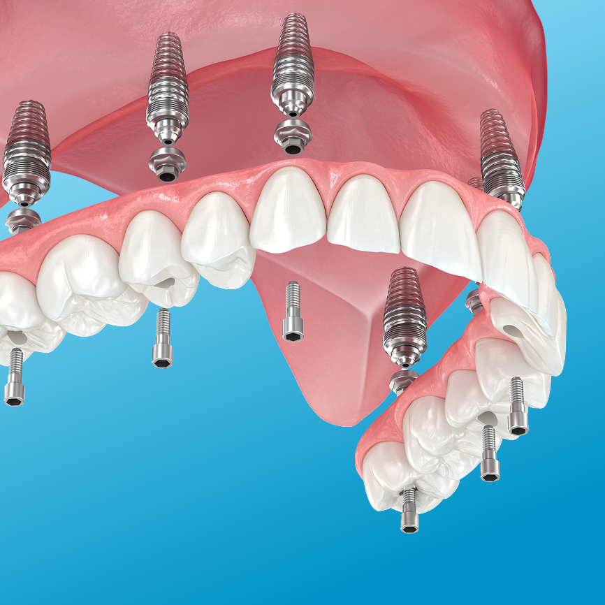 Implant denture