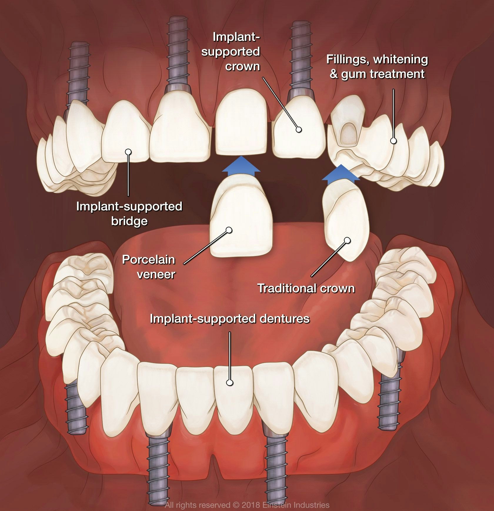 Illustration of multiple restorative techniques, including implant-supported crown, implant-supported bridge, fillings, whitening, and gum treatment, porcelain veneer, traditional crown