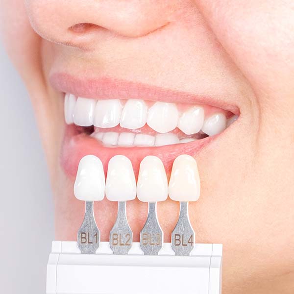 Comparing veneer shade to teeth