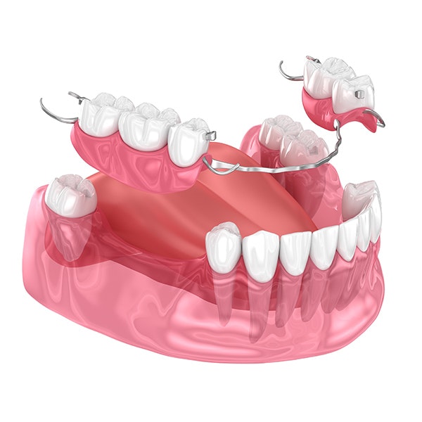 Partial denture