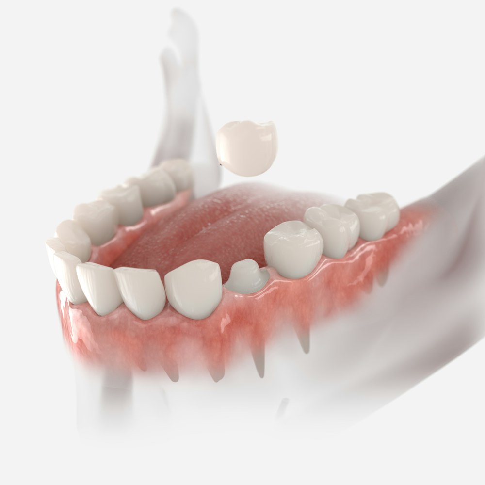 Crown being placed over a prepared tooth