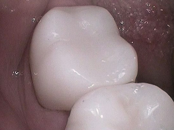 After dental crown photo