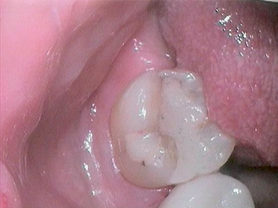 Before dental crown photo