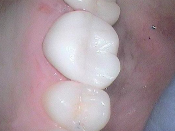 After Crown Replacement Photo