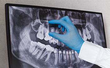 Root canal treatment