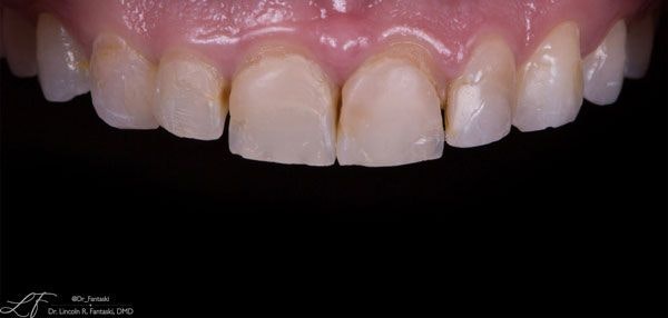 Verde Pointe Dental Associates's patient before smile makeover