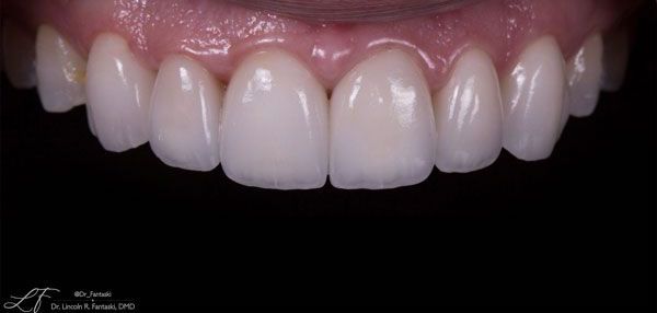 Verde Pointe Dental Associates's after smile makeover