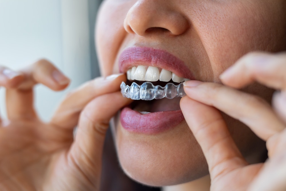 Woman placing invisalign braces on her teeth close up