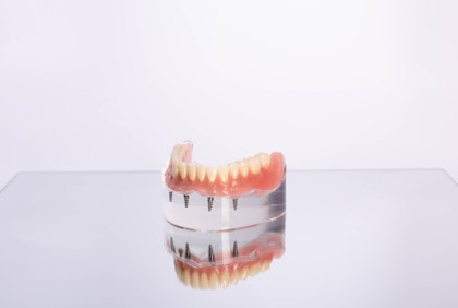 All-on-4 dental implant model