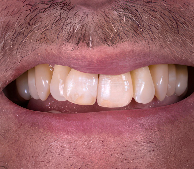 before and after dental work