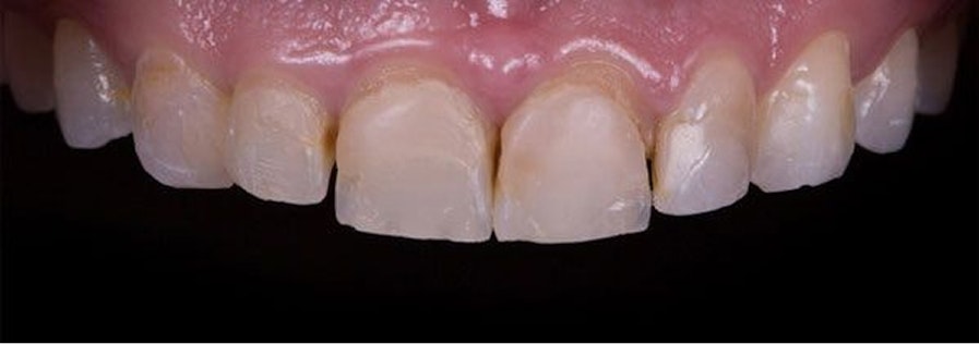 Patient teeth before bonding
