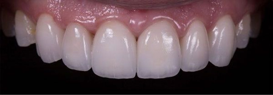 Patient teeth after bonding