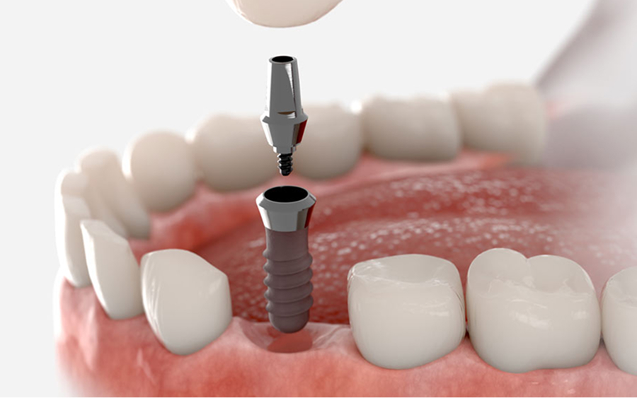 Dental implant