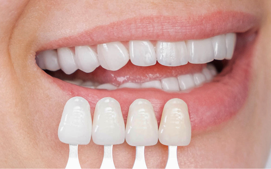Veneer options