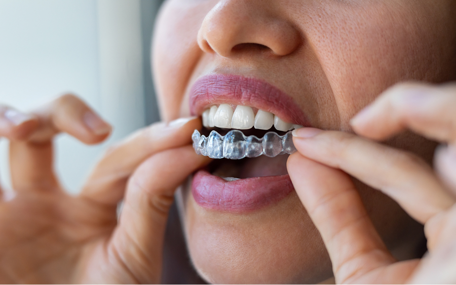 Woman putting in Invisalign tray