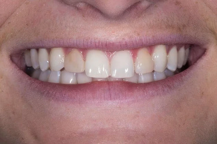 Real Verde Pointe Dental Patient Before Veneers Photo