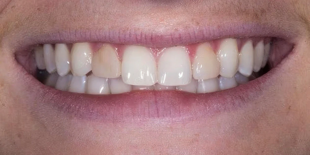 Real Verde Pointe Dental Patient Before Veneers Photo