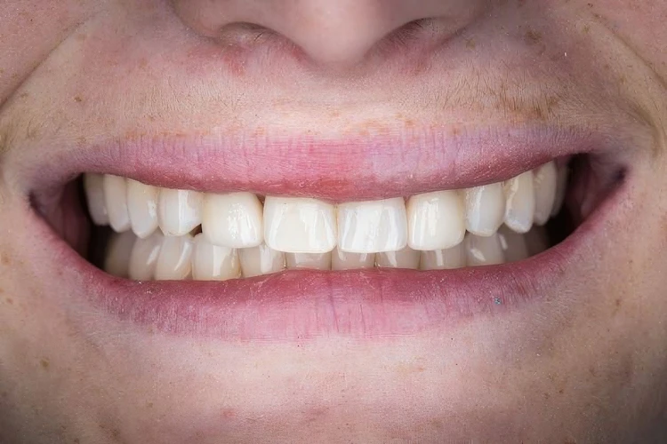 Real Verde Pointe Dental Patient After Veneers Photo