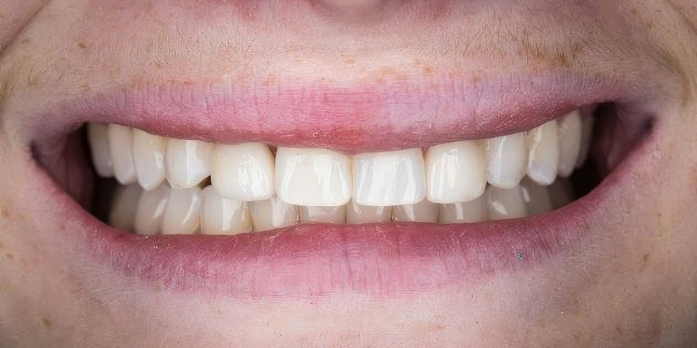 Real Verde Pointe Dental Patient After Veneers Photo