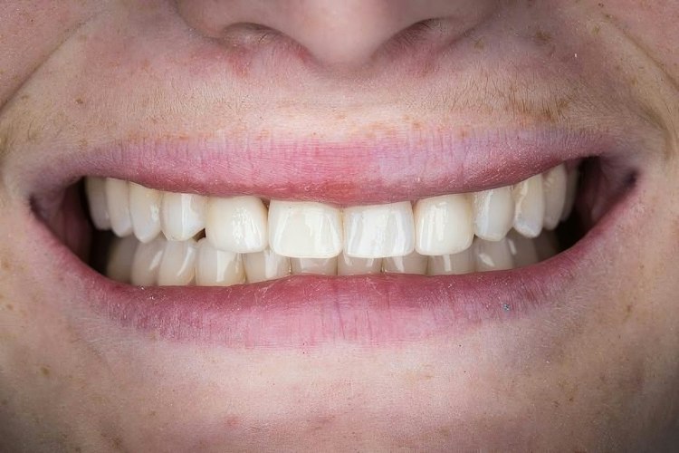 Real Verde Pointe Dental Patient After Veneers Photo