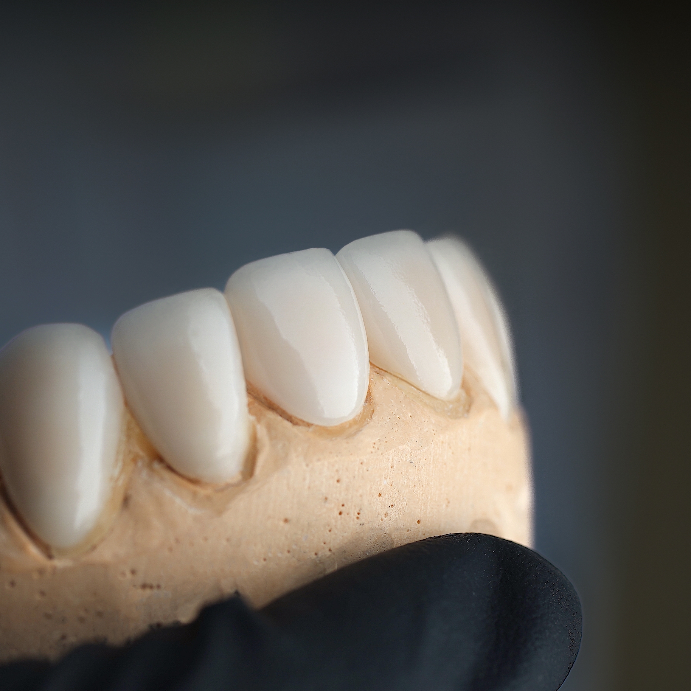 Model of Veneers