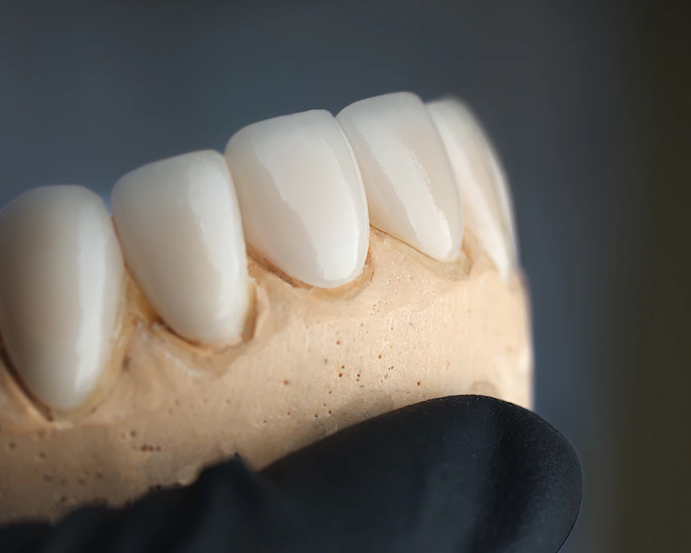 Model of Veneers