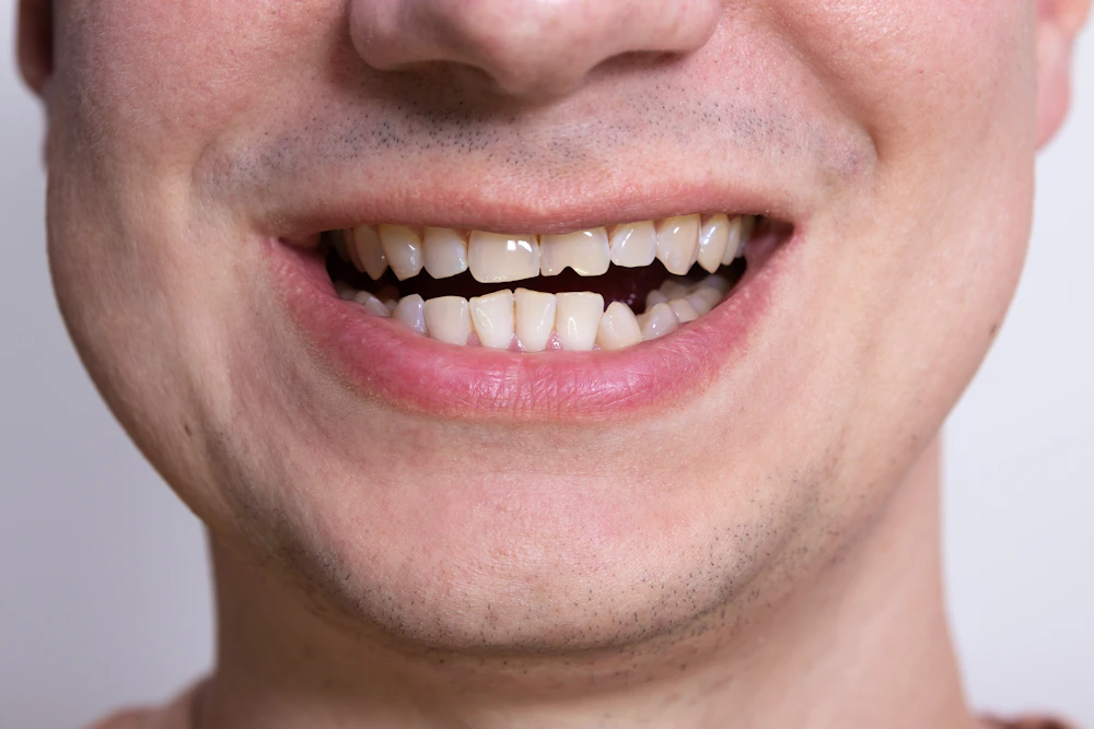 Close up of mouth with crooked teeth