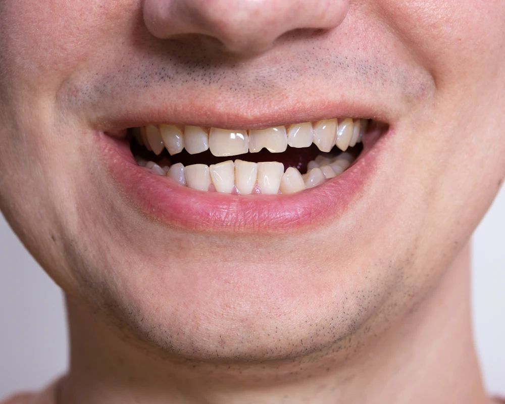 Close up of mouth with crooked teeth