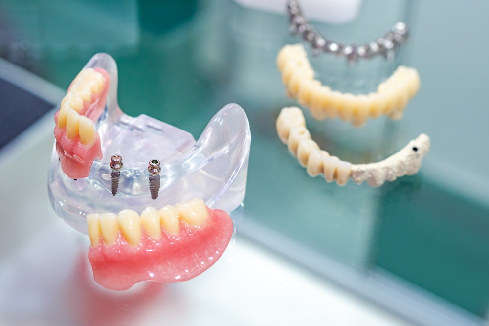 Mini Dental Implants