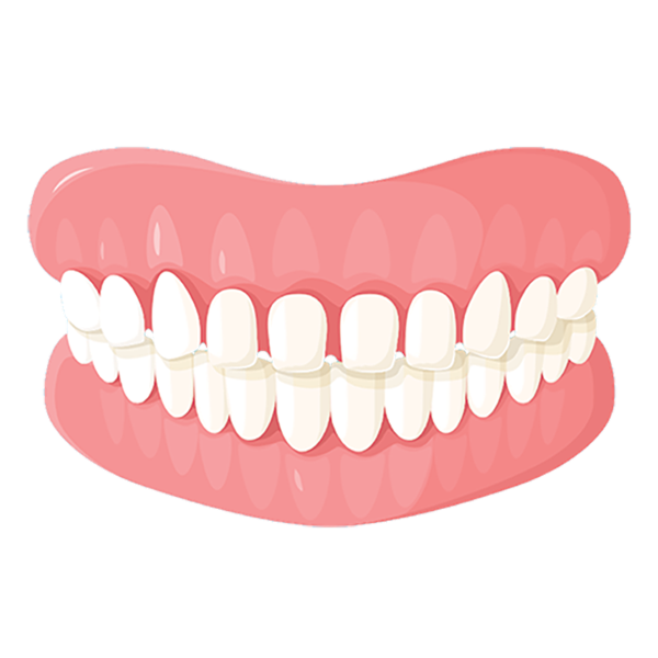 Illustration of gapped teeth